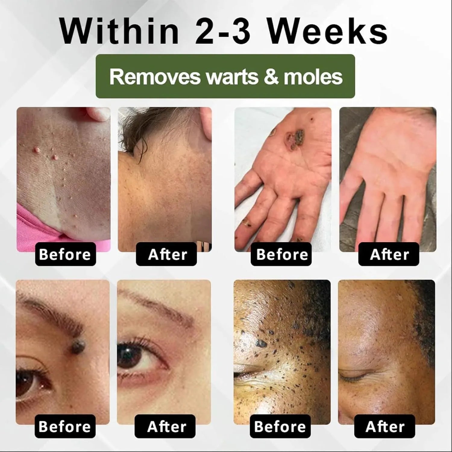 Natureerase Instant Mole Spot Removal Gel 45g tube for facial and body skincare treatment