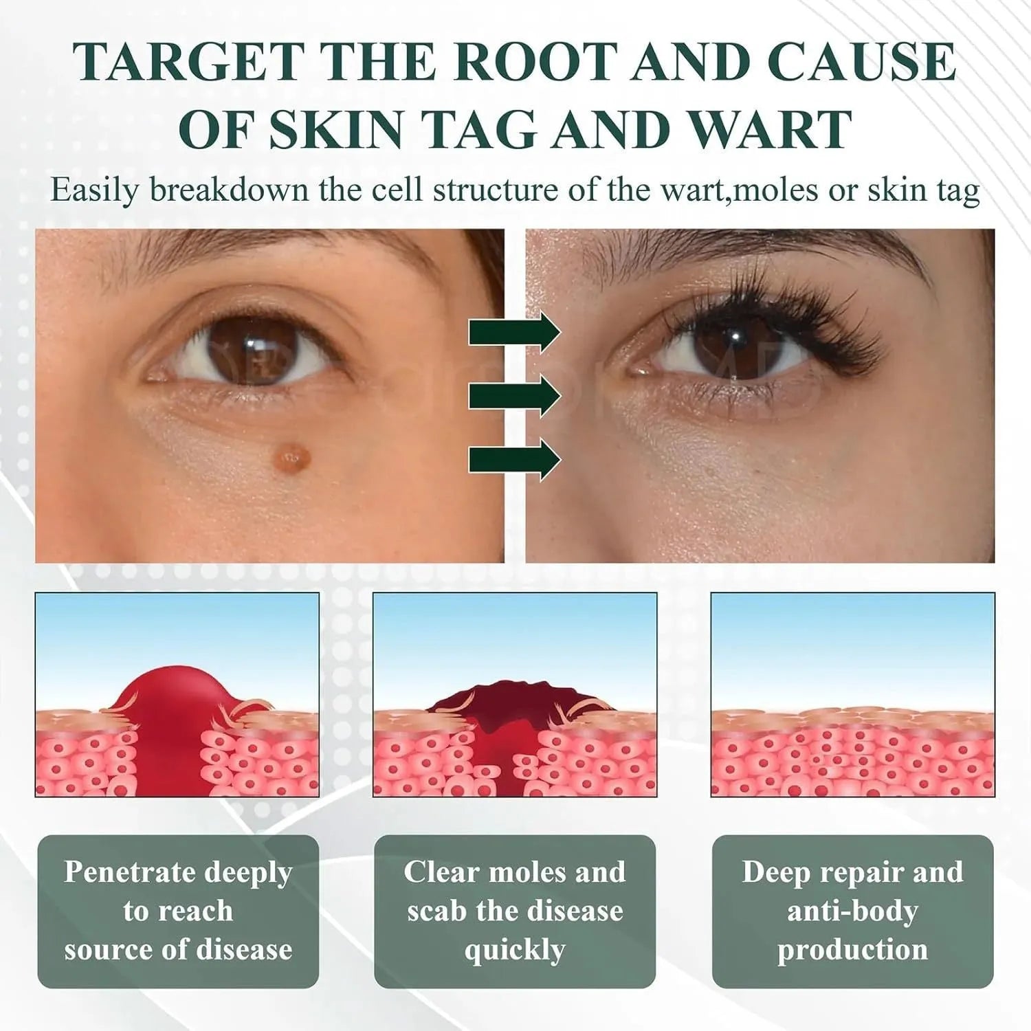 Natureerase Instant Mole Spot Removal Gel 45g tube for facial and body skincare treatment